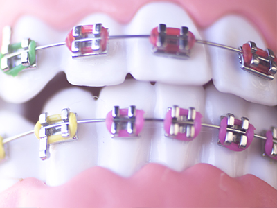 Colorful braces on a person s teeth, with a close-up view of the bracket and wire details.